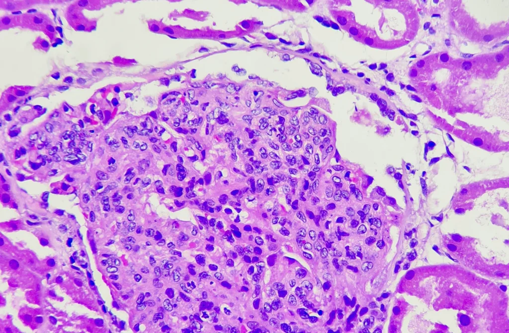 Profiling Urine Methylation in Lupus Nephritis