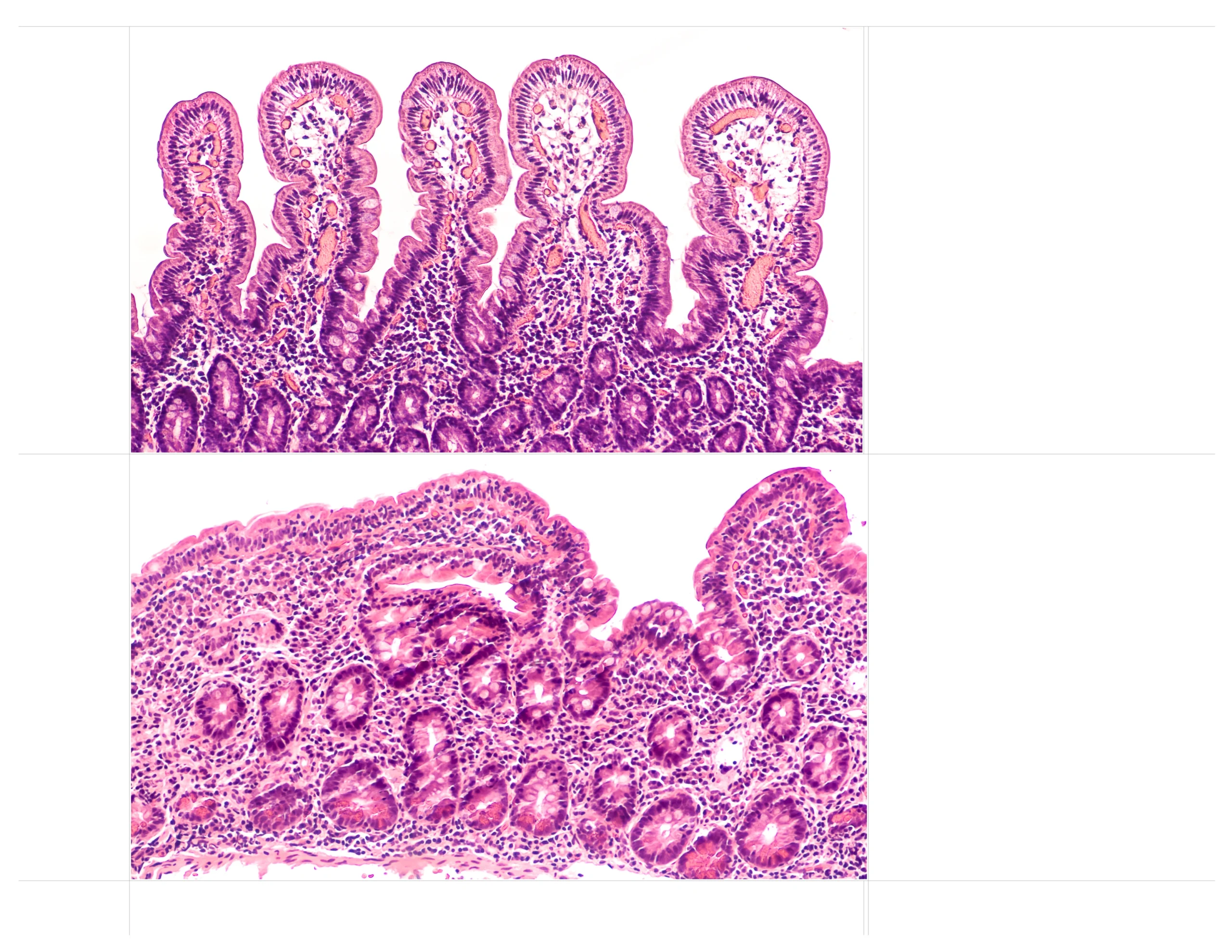Developing a Molecular Microscope for Celiac Disease